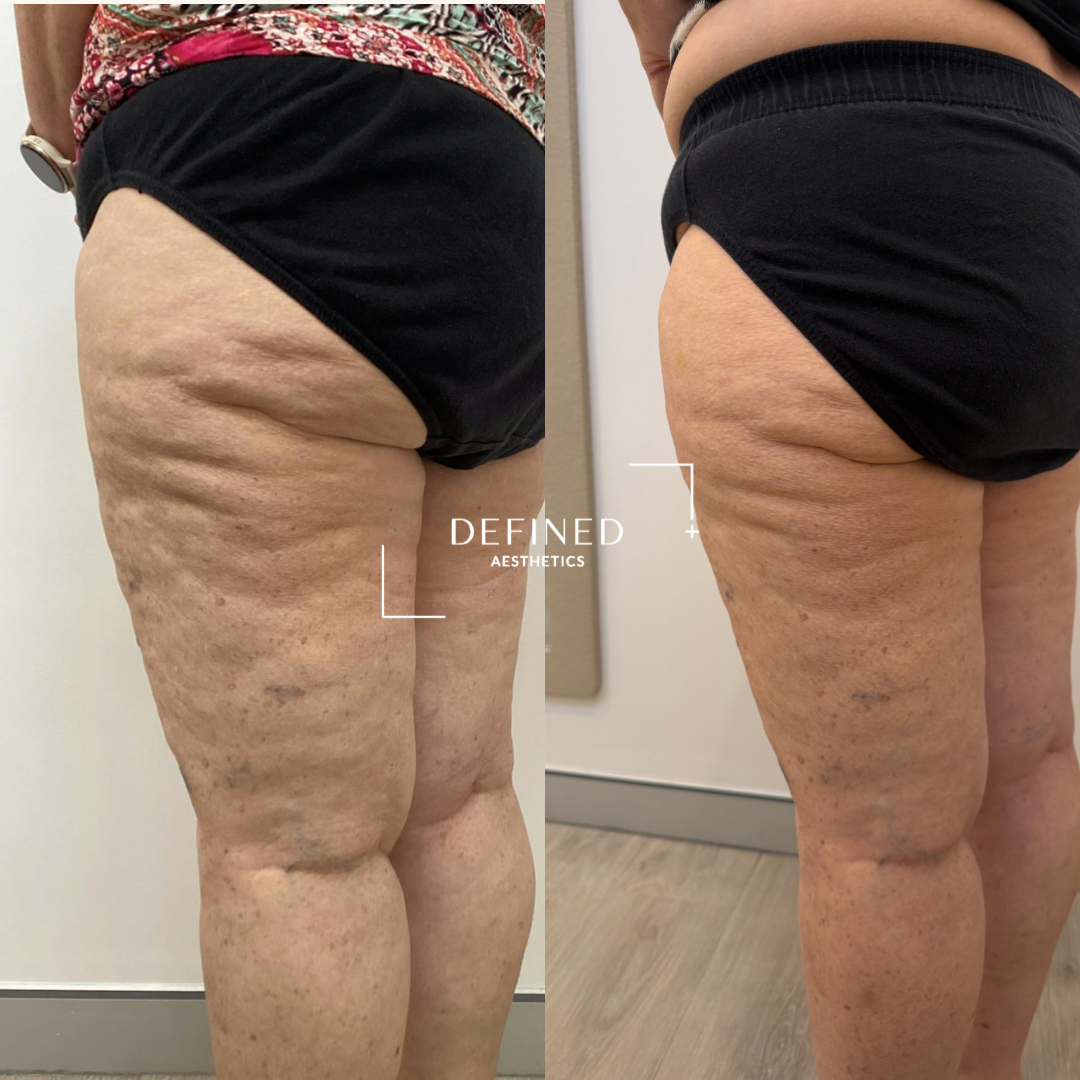 The complete clinic-supplied before-and-after body comparison, shown without retouching