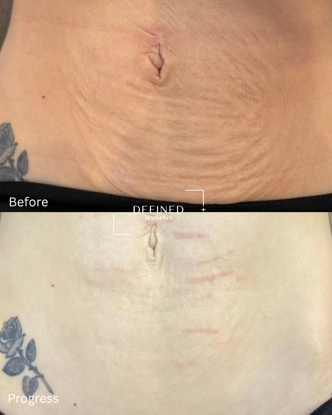 Abdomen · skin tightening — original before-and-progress photographs