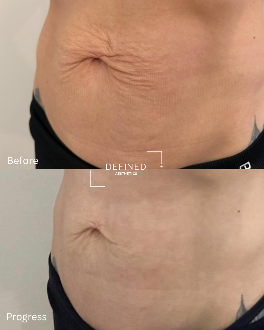 Abdomen profile · skin tightening — original before-and-progress photographs
