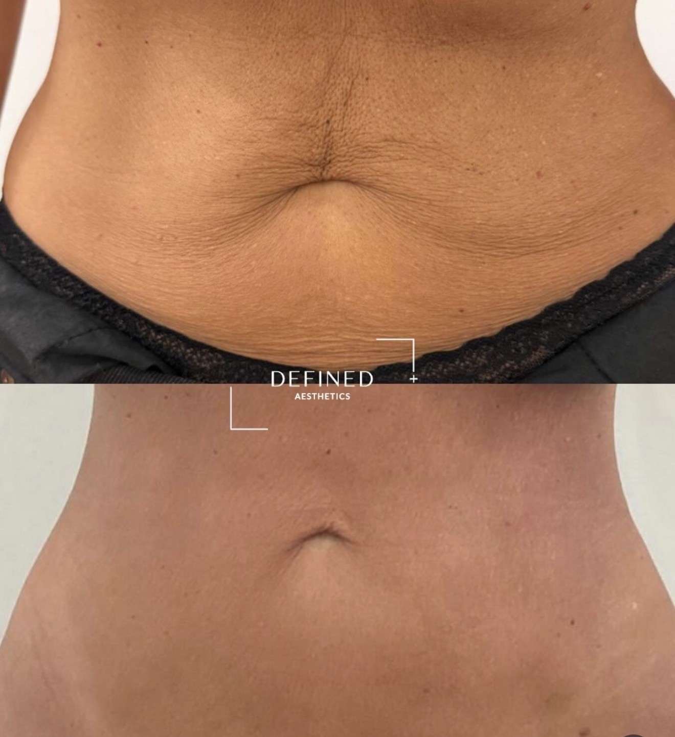 Abdomen · skin tightening — clinic-supplied comparison