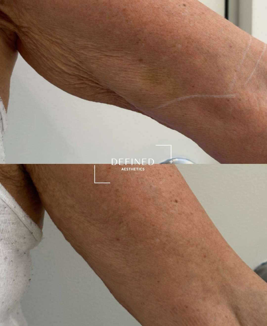 Upper arm · skin tightening — clinic-supplied comparison