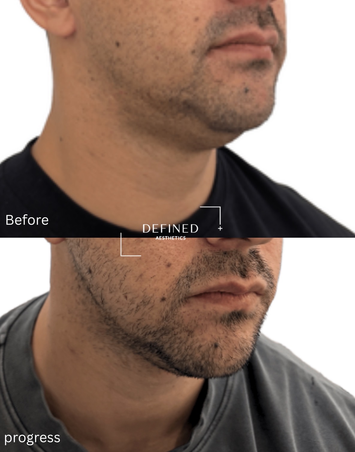 Double chin · fat reduction — original before-and-progress photographs