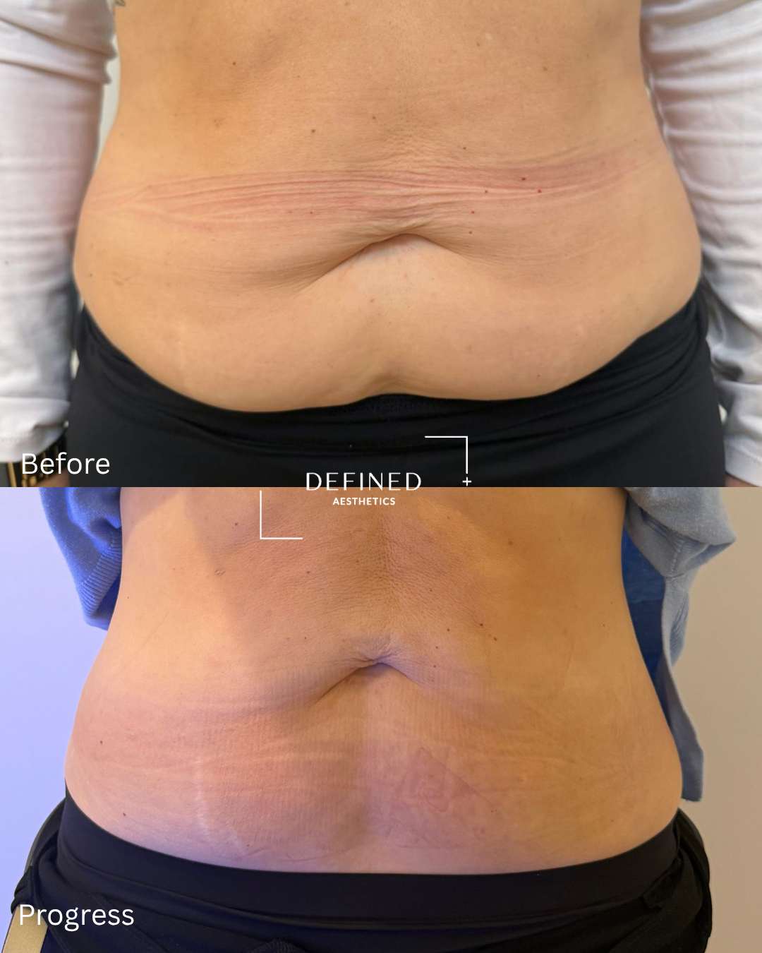 EMS · muscle toning — clinic-supplied comparison