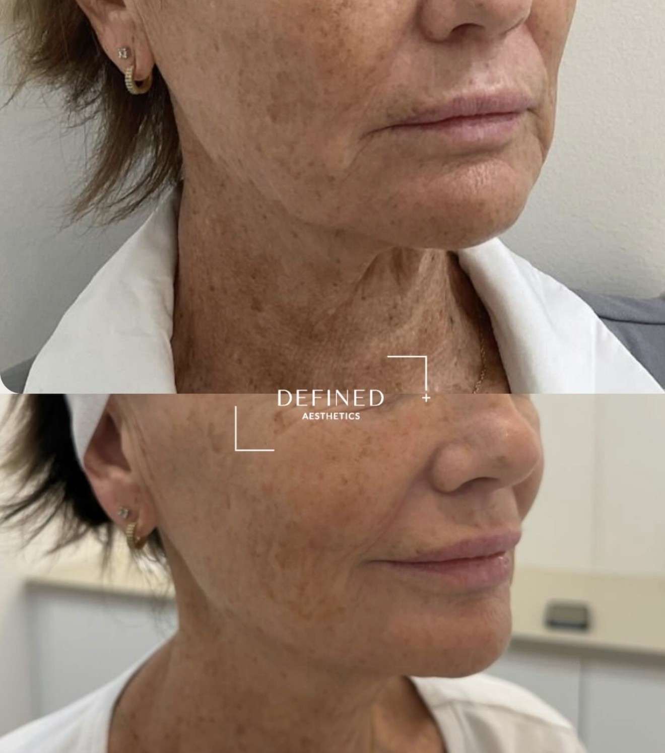 Face, neck & jawline — clinic-supplied comparison