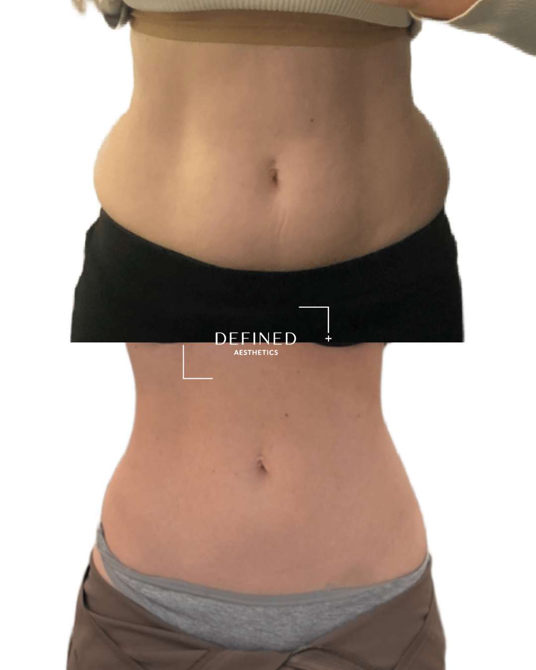 Abdomen · fat reduction — clinic-supplied comparison