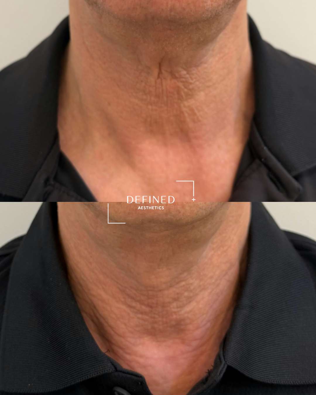 Neck · firmness & texture — clinic-supplied comparison