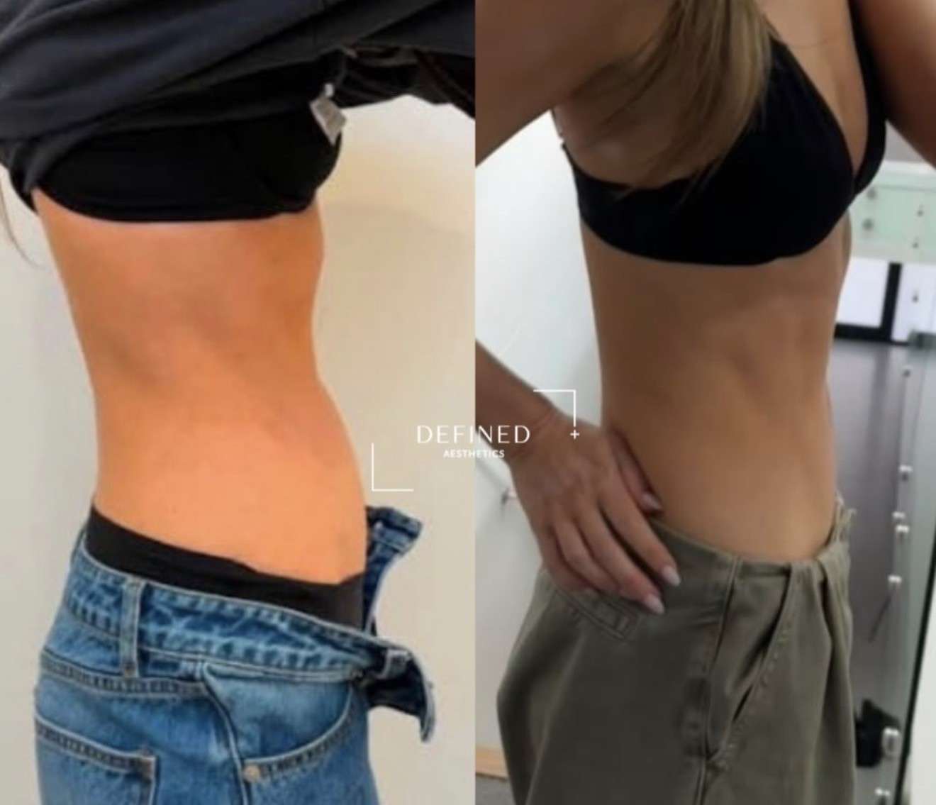 Post-pregnancy · core toning — clinic-supplied comparison